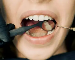 Nettoyage professionnel des dents